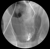 tratamiento de la hiperplasia benigna de próstata mediante embolización arterial tratamiento de la hiperplasia benigna de próstata mediante embolización arterial